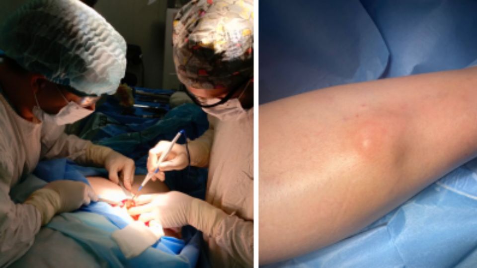 В Челябинском онкоцентре впервые выполнили сложнейшую костно-пластическую операцию