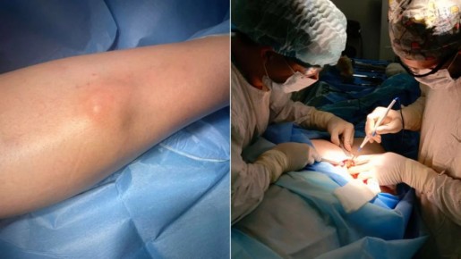 Онкологи Челябинска освоили методику операций с поражением костей